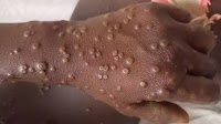 US Provides $4.1 Million to Support Mpox Response