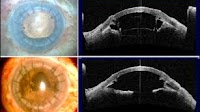 Urrets-Zavalia syndrome another indication for single-pass four-throw pupilloplasty