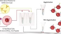 Rapid Gel Card Agglutination Assays for Serological Analysis Following SARS-CoV-2 Infection in Humans