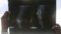 Oestrogen drop leaves postmenopausal women vulnerable to bone disease
