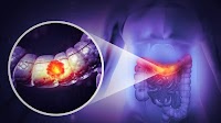Vitamin D curbs colorectal cancer by boosting immunity and blocking tumor growth