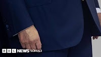 Muxuu yahay xanuunkan Donald Trump laga soo sheegay