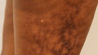 What Is Toasted Skin Syndrome? Cause, Signs and How To Treat It