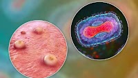 Zelsuvmi Topical Gel Now Available for Molluscum Contagiosum Treatment