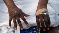 Ghana records 21 new Mpox cases, total now 218 – GHS