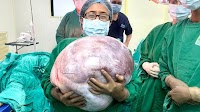 Jehangir Hospital surgeons successfully remove 18-kilogram ovarian tumour from 68-year-old woman