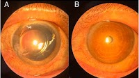 Urrets-Zavalia syndrome following placement of scleral-sutured intraocular lens