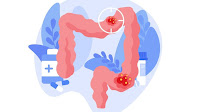 Doctor’s Note: Colorectal Cancer— A Mad Dog in the Gut