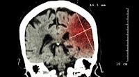 Benzodiazepines Increase Stroke Risk in Alzheimer’s