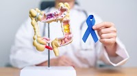 Lifestyle interventions in patients after colorectal cancer treatment