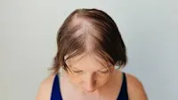 Ritlecitinib bei Alopecia areata untersucht
