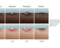 Imagem de Mpox lesions in different stages