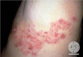 Image result for "Herpes Zoster"