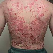 Image result for eczema