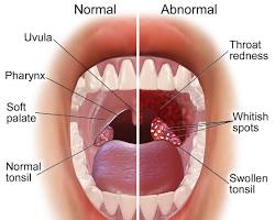 Image of Sore throat