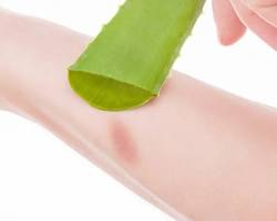 Image of Aloe Vera for Burns