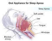 Image of oral appliance for sleep apnea