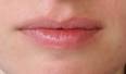 Red line under lower lip - Doctor on HealthcareMagic