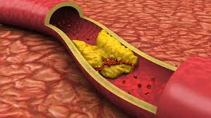 Image result for progressive vascular diseases