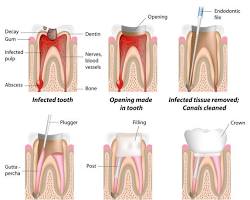 Image of root canal procedure steps