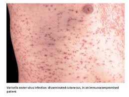 Image result for "Herpes Zoster"