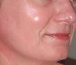 Behandling av rosacea