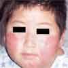 December 01, 2006 | Pediatric Skin Diseases, Atopic Dermatitis. By Nathan Hitzeman, MD and Mimi Reiss, MD - 0612ConPPCAJD1_thumbnail