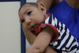 Image result for images of zika babies