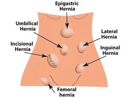 Femoral hernia in the body
