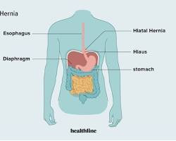 Hiatal hernia in the body