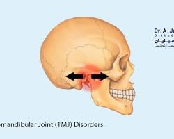 صورة أمراض المفصل الصدغي الفكي (TMJ)