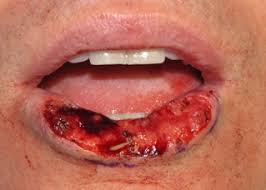Image result for kanker