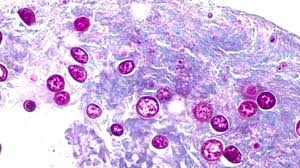 Estados Unidos vive el mayor brote de ciclosporiasis de su historia: más de 11.000 casos y cientos de hospitalizaciones por lechuga contaminada