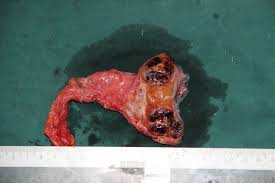 Image result for teratoma