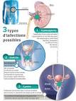 Infection urinaire : de laposorigine au traitement