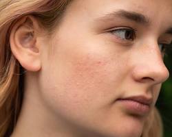 Image of Rosacea skin