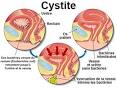 Cystite symptomes