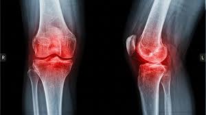 Scientists discover simple way to relieve arthritis pain ...