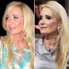 Before &amp; After Picture of Kim Richards Rhinoplasty, performed by Dr. Vladimir Grigoryants; photo provided by intouchweekly.com - gI_62930_Kim%2520Richards