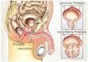 Prostataentz ndung (Prostatitis) Therapie