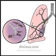 Lung Collapse - Medical Disability Guidelines