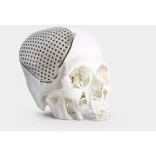 Patient Specific Implant - 3D Incredible
