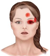 Cluster Headaches