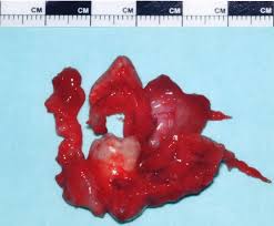 Image result for dentigerous cyst of supernumerary tooth