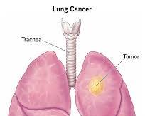 Image of Lung cancer lungs