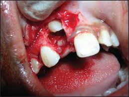 Image result for crowding due to supernumerary teeth