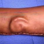  A soldier lost her ear in a car accident. So the doctors grew her a new one -- on her forearm