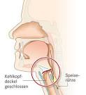 Mandelentzündung (Tonsillitis) - Symptome, Krankheitsverlauf