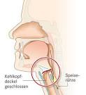 Verschleimter Hals - was tun?