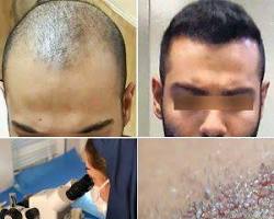 Image of نتائج زراعة الشعر قبل وبعد في عيادات الرياض للرجال والنساء hair transplant results before and after Riyadh clinics